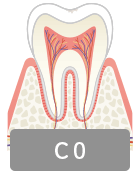 虫歯の進行C0