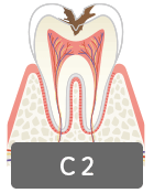 虫歯の進行C2