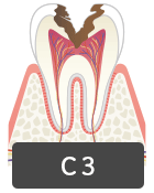 虫歯の進行C3