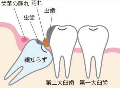 親知らずが虫歯や歯周病になっている場合は抜歯を推奨